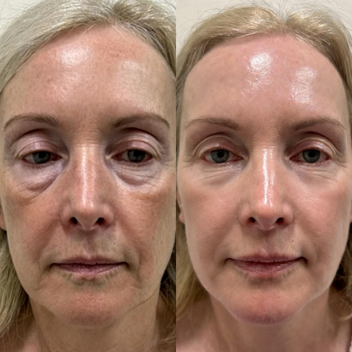 Medicube Bálsamo Antiedad GLOW SKIN – Efecto Lifting, Firmeza y Volumen
